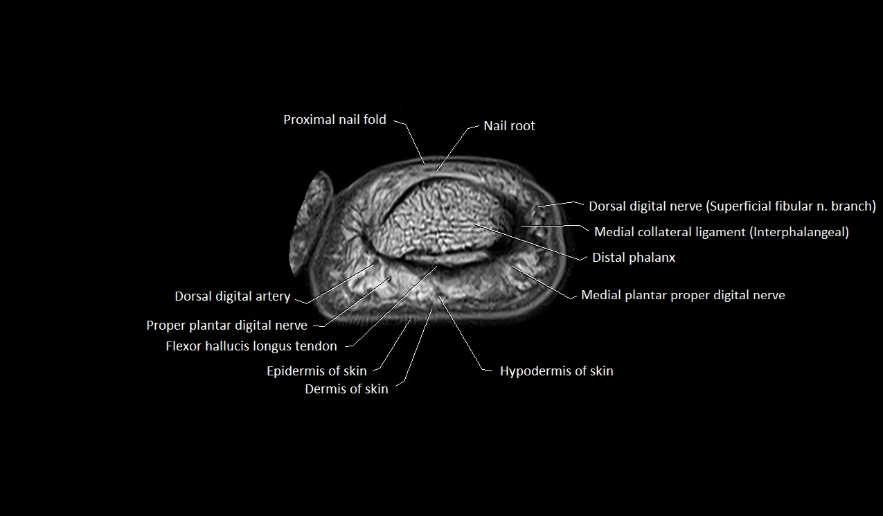 Great toe (hallux) axial microanatomy 3T MRI image 10.webp